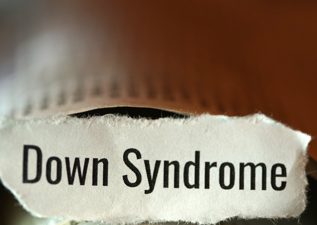 síndrome de Down